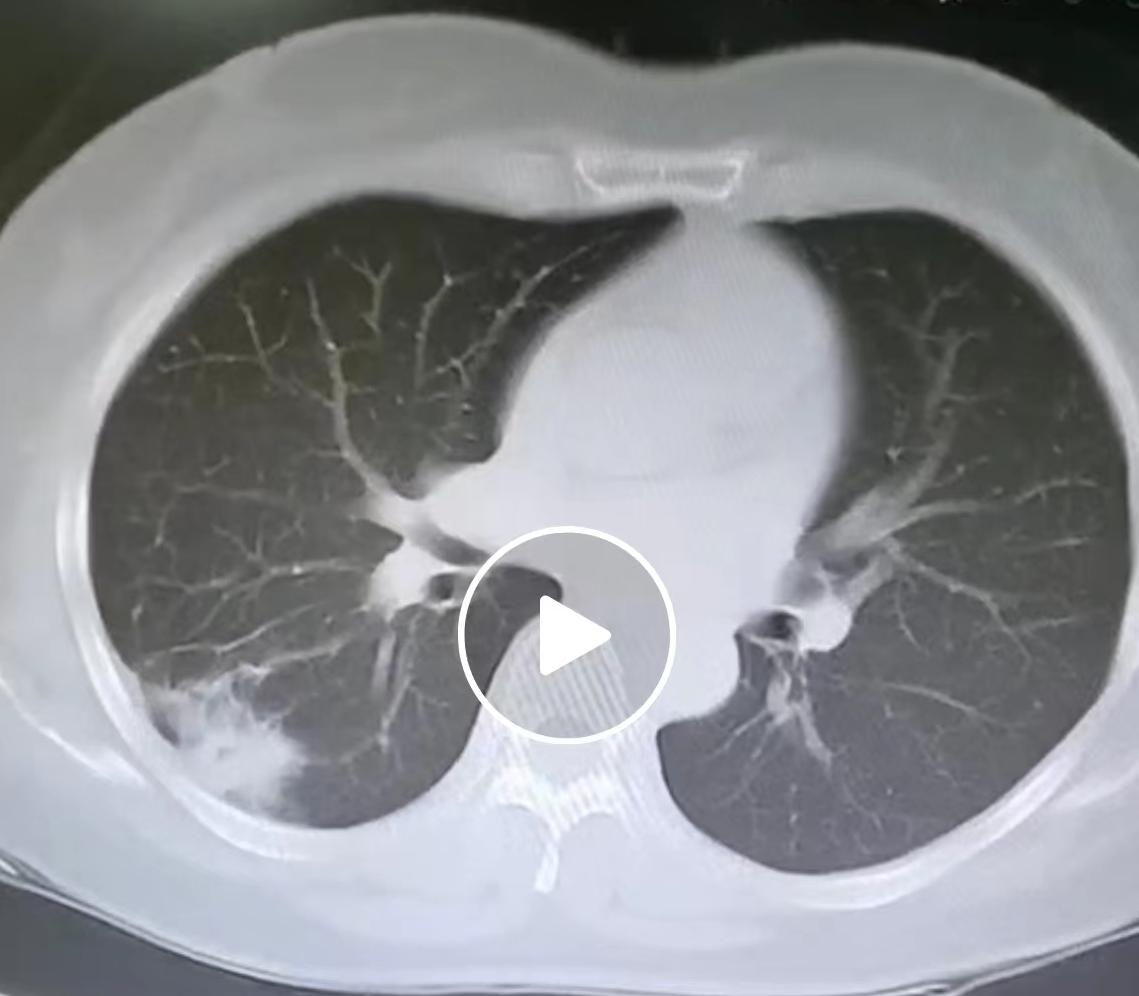 做了一台让我印象很深的肺癌手术，值得和大家分享一下！患者是一位50岁的女士，肺里