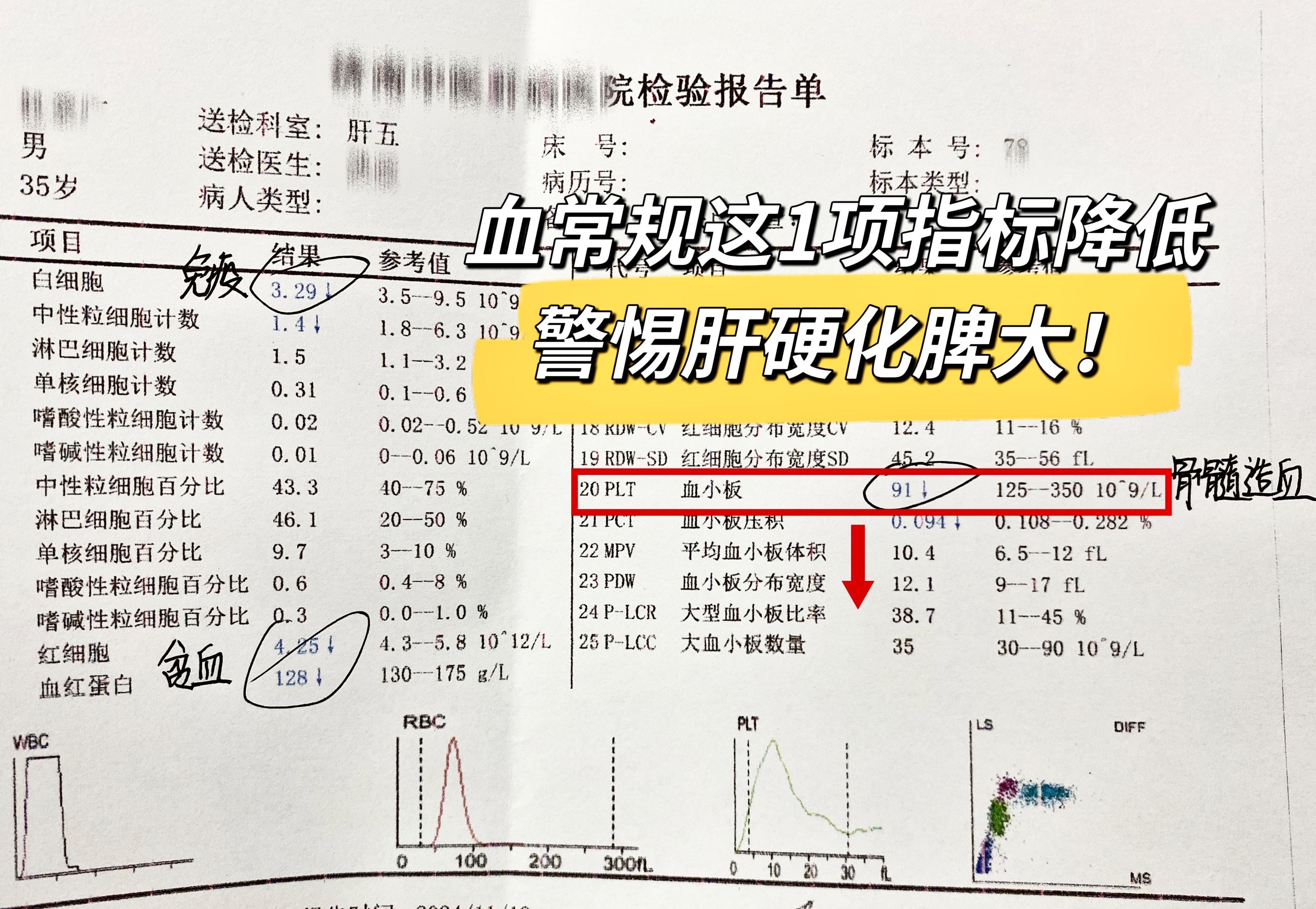 血常规这1项指标降低，警惕肝硬化脾大！。给大家看这张化验单，白细胞和血...