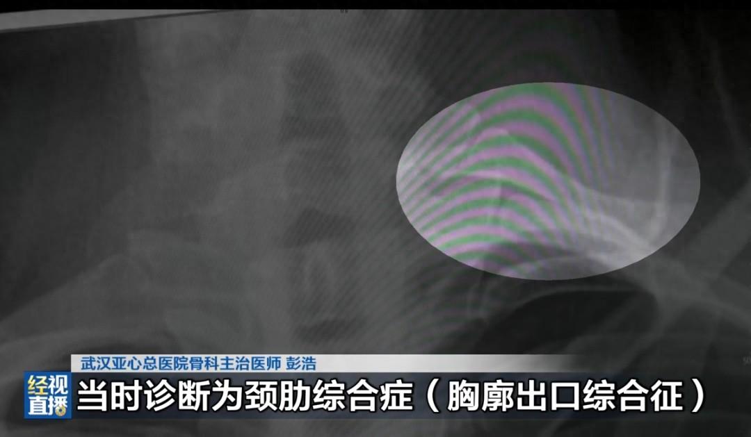 “万万没想到！”9月13日报道，湖北武汉，一女子被颈痛、手麻折磨了一年，每次脖子
