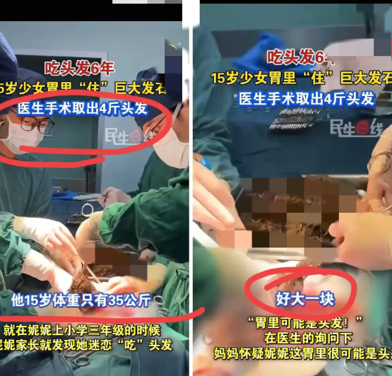 震惊！河南一女孩因腹痛吃不下饭，去医院看病，不料，医生竟从她的胃里，发现一颗堪