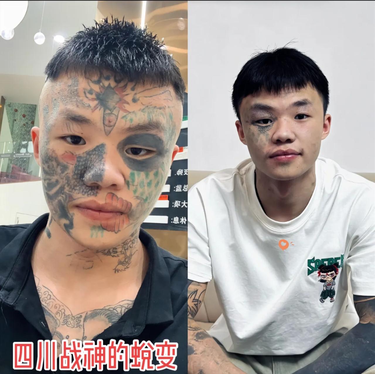 “这下后悔了吧！”06年出生的广东男孩夏朝勇正硬扛着第五次激光洗纹身。