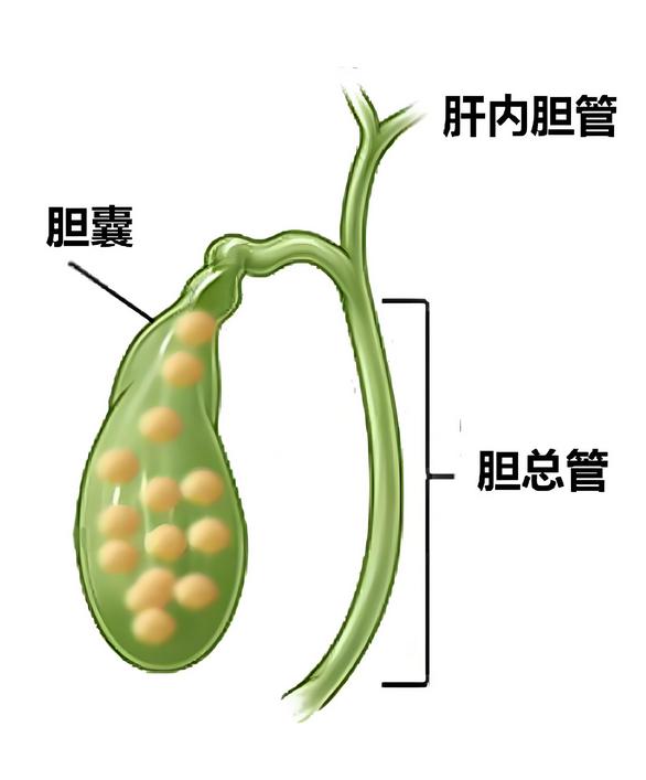 胆结石还是胆囊炎？1分钟自测胆囊问题 经常右上腹不适，却分不清是胆结石还是