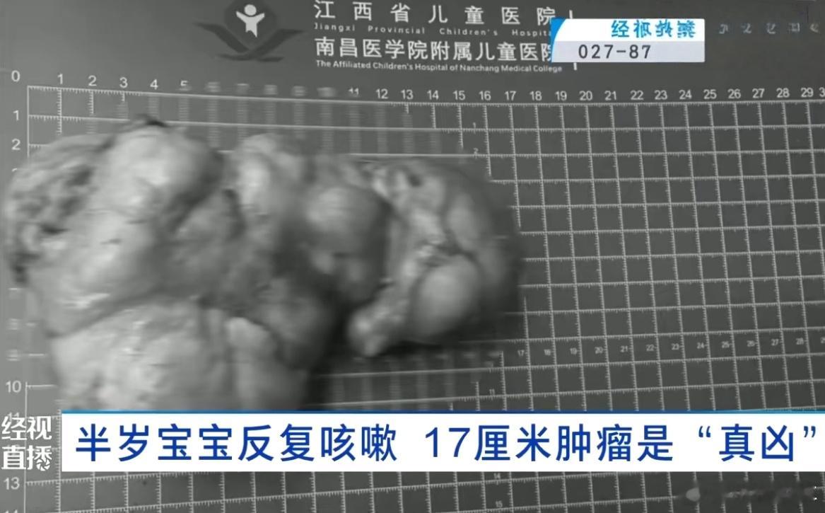 半岁宝宝反复咳体内取出17厘米巨瘤我的天呐，看着也太吓人，这也太遭罪了​​​