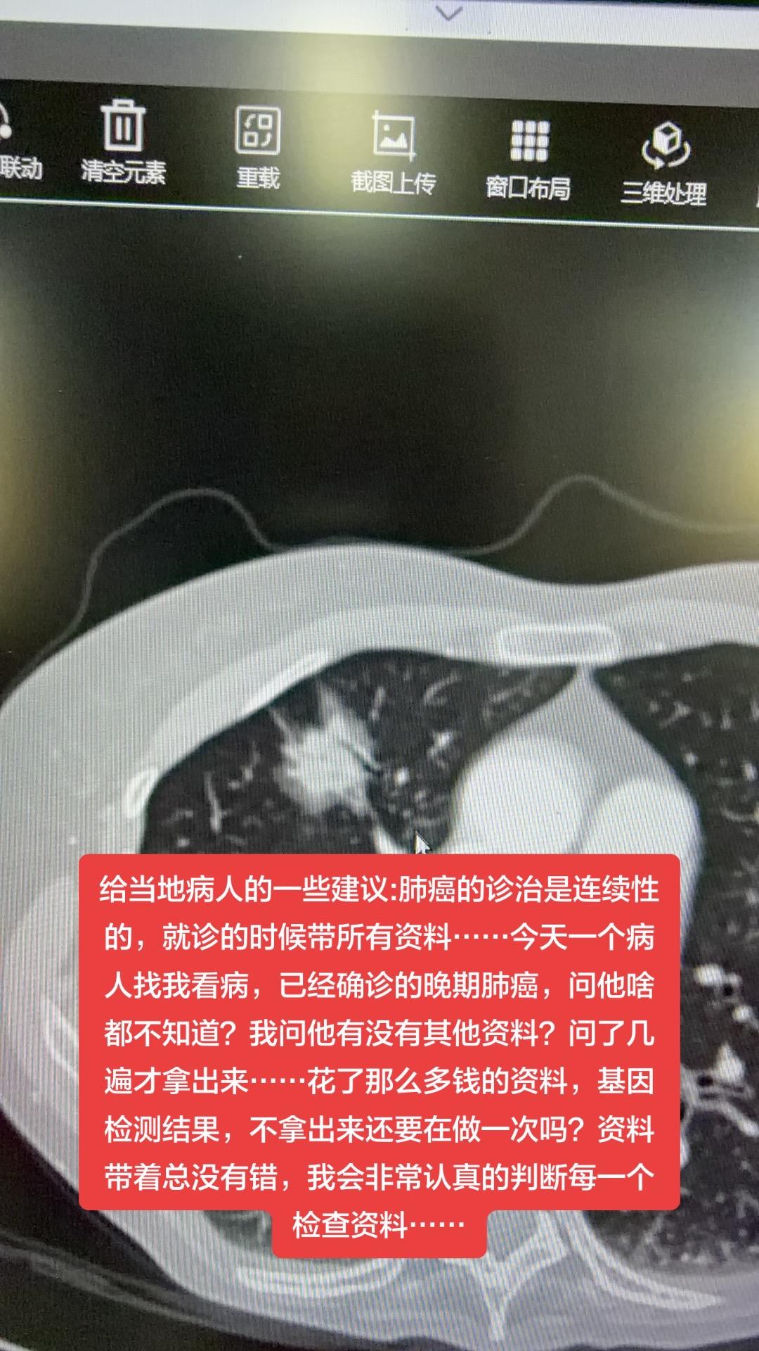 给当地病人的一些建议:肺癌的诊治是连续性的，就诊的时候带所有资料……今...