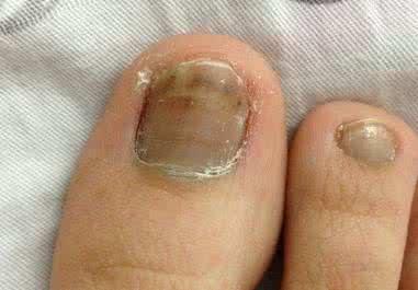 专家来解读: 如何才能彻底远离灰指甲的困扰?
