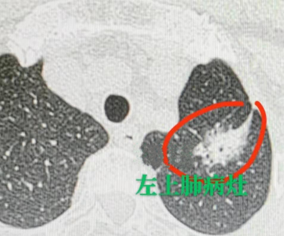 一听到肺癌，脑海里浮现的第一个症状可能就是咳嗽、咯血，这没错，但你知道吗？肺癌有