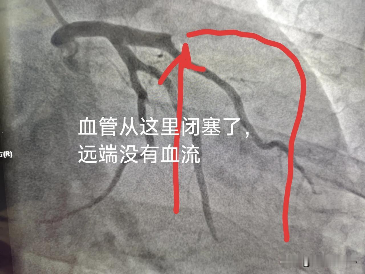 昨天晚上十二点左右，刚躺下没多久，电话就响了，一个37岁男性，突发胸痛，做了