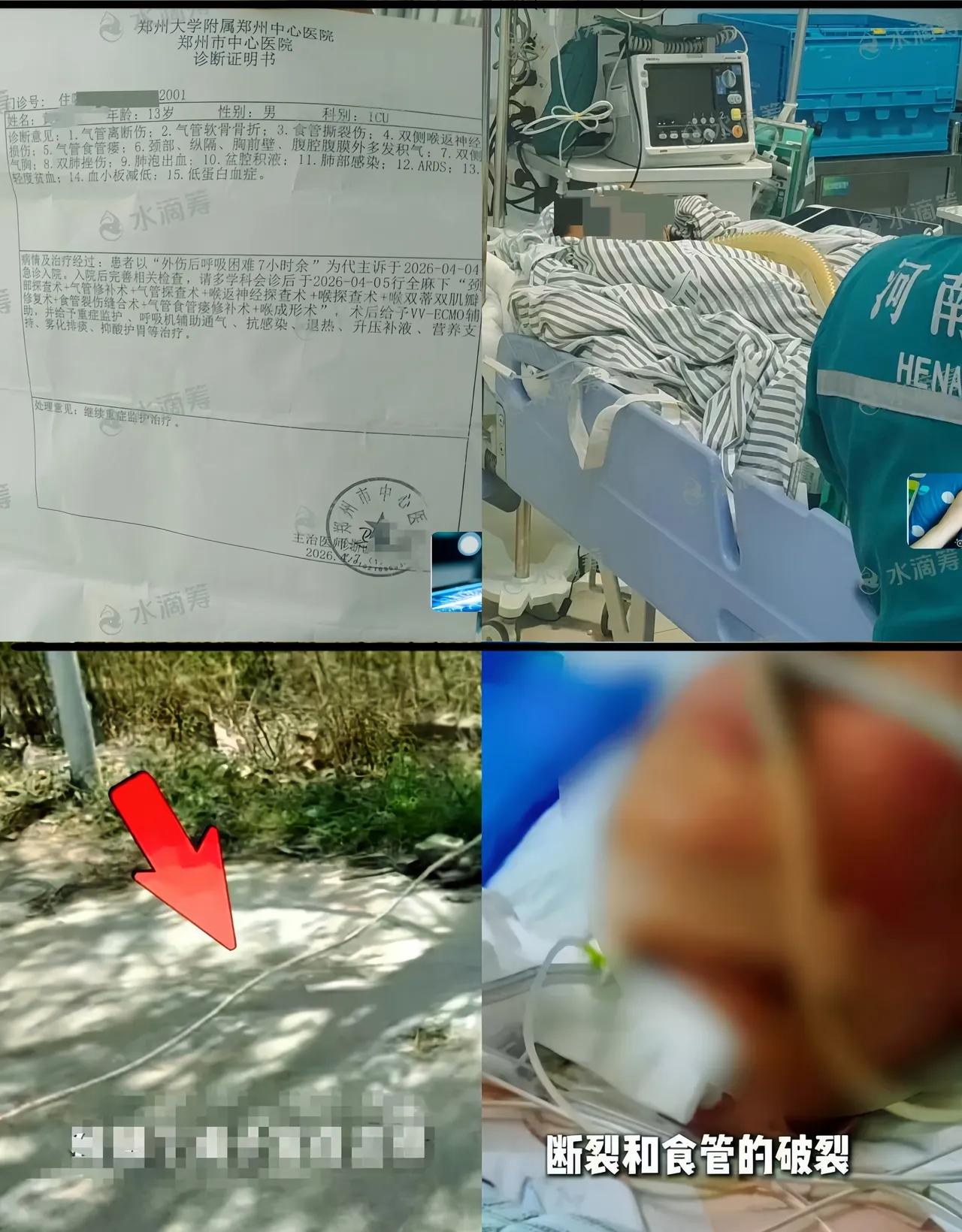 刑事强制措施！私拉绳子致男孩割断喉管气管的老人朱某雨被抓了，她是柏香一街的村民