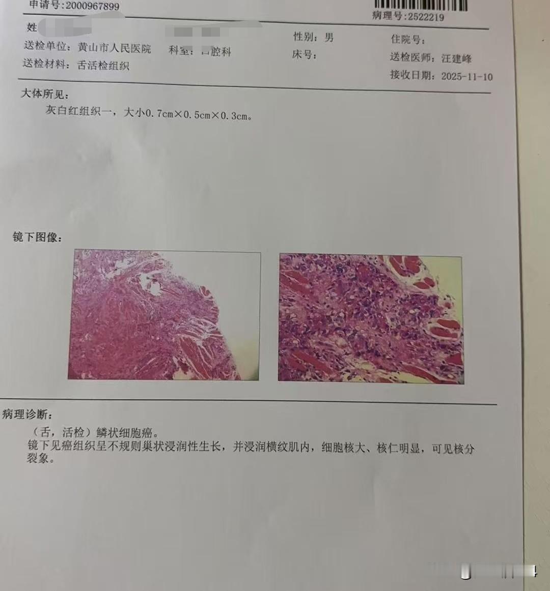 大哥患上口腔癌，刚做了手术，不知道有没有转移…六月份开始，大哥吃