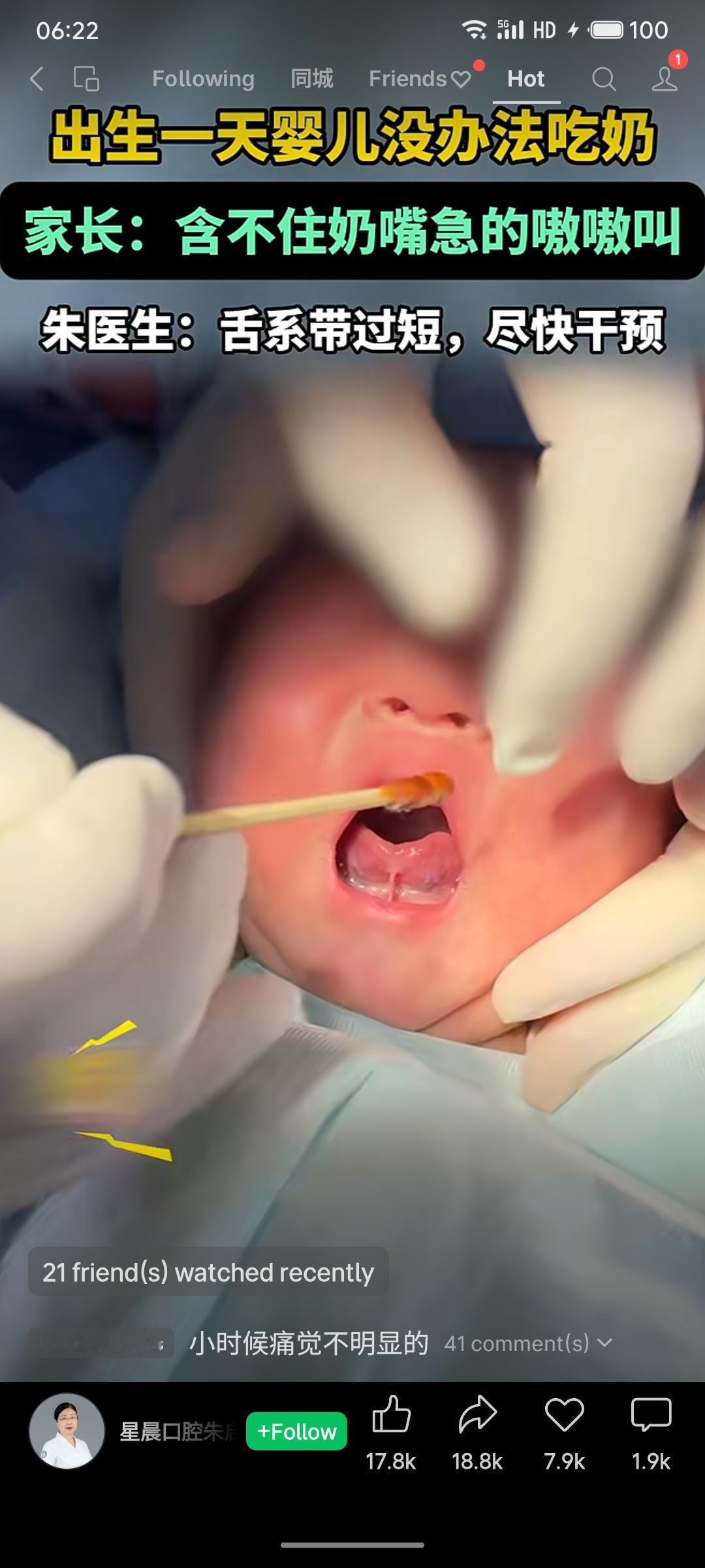 一名出生仅一天的婴儿因无法含住奶嘴、进食困难,经医生诊断为舌系带过短。医生建议尽