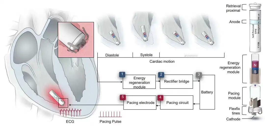 全球首创！中国造胶囊起搏器，心跳发电终身免换别再被传统起搏器的“终身手术魔