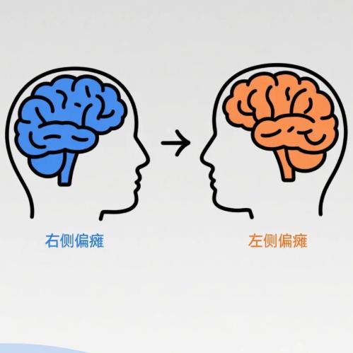 偏瘫左侧vs右侧，康复速度差一倍？大实话告诉你同样是偏瘫，左侧瘫和右侧瘫，恢
