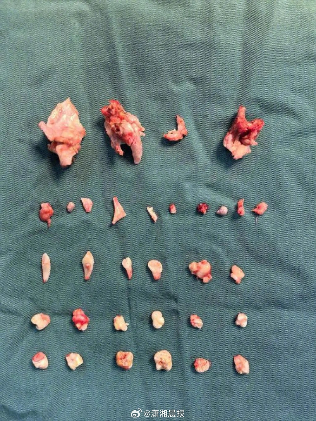 【18#女孩跳操腹痛不止腹中发现巨大肿块#，#18岁女孩腹中肿块里还有24颗牙齿