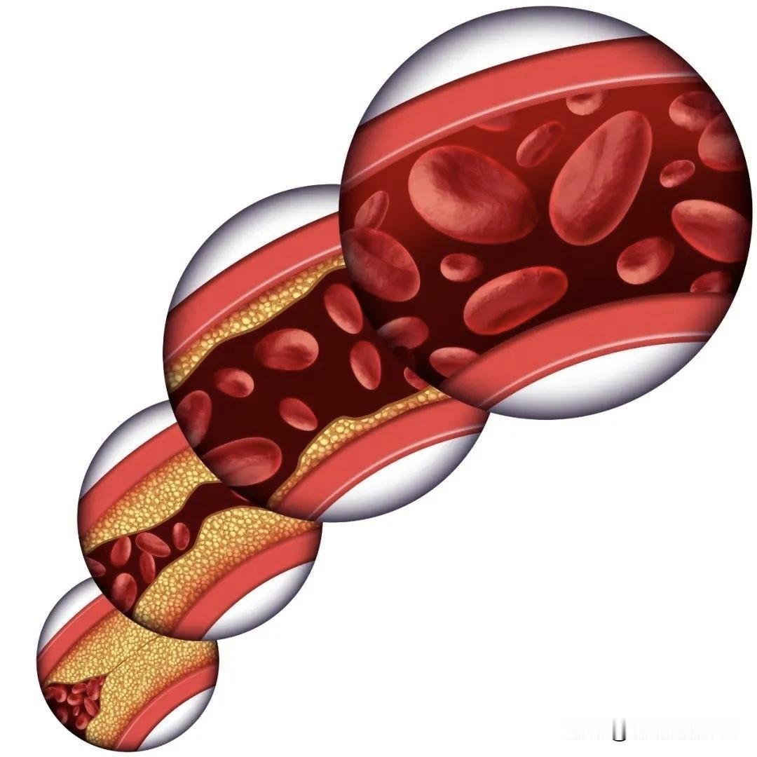 稳定、缩小血管斑块，别只依赖他汀！5个中成药协同调理，安全又可靠血管斑块是