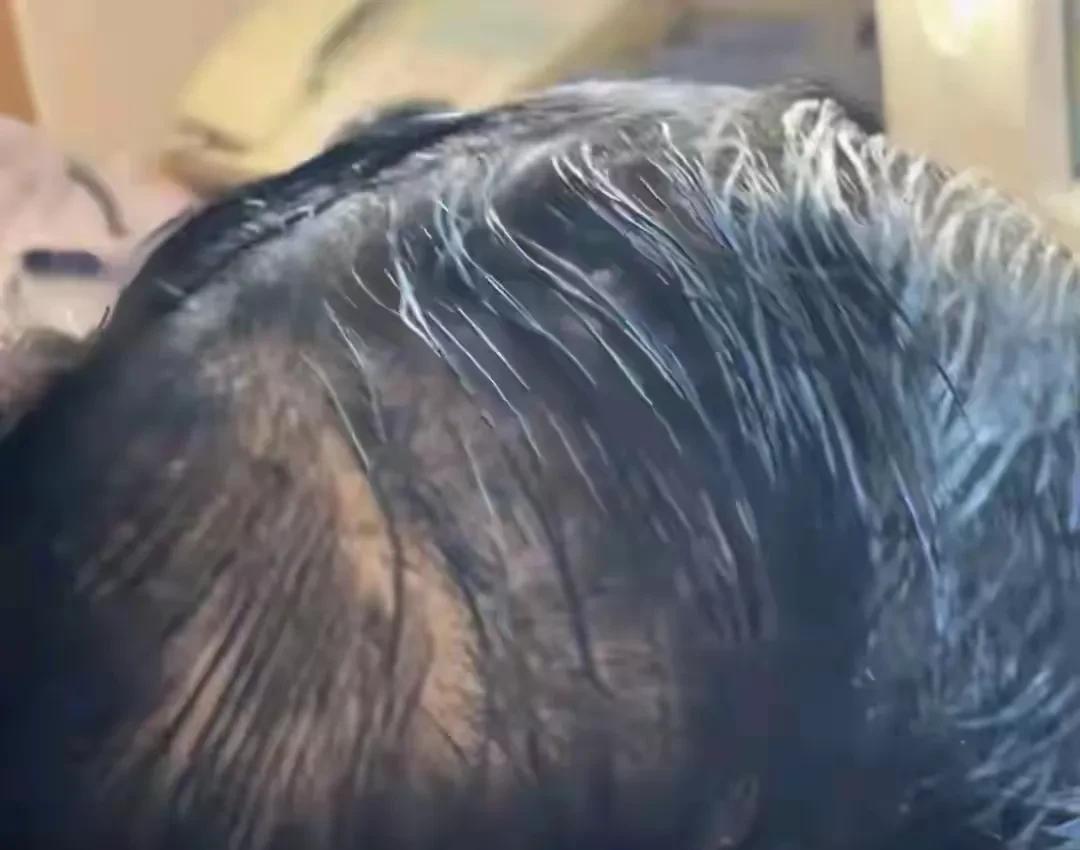 原来黄晓明那乌黑浓密的头发都是假的呀！看这头发少的都要谢顶了，难怪小教主曾经说
