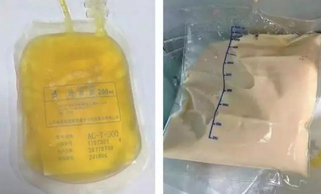 27岁姑娘甘油三酯超标18倍, 血浆变猪油色, 医生却说: 少见多怪