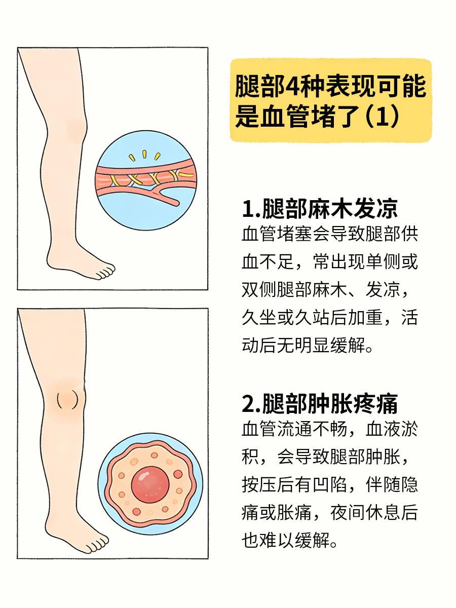 腿部出现这4种表现，可能血管堵了腿部血管健康容易被忽视，一旦出现堵塞，会影响血