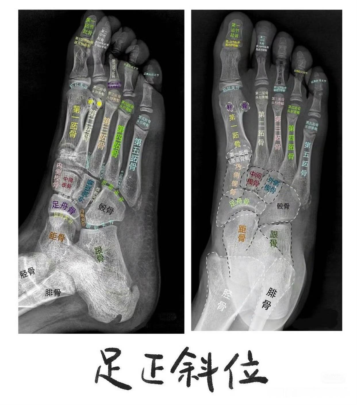 足踝疼痛盘点【足踝结构详解】我们的足骨由26块骨组成——跗骨、跖骨、趾骨，这三