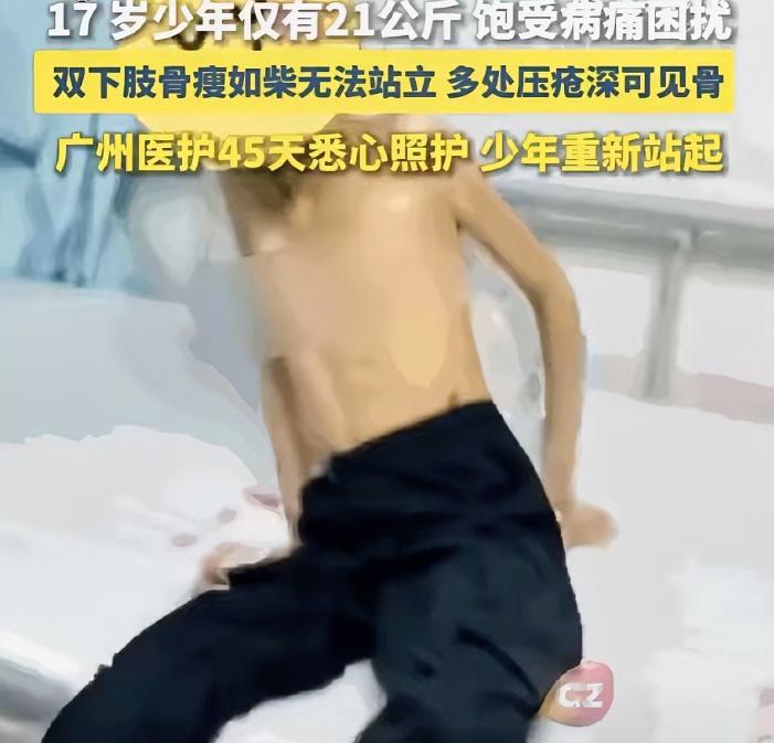 悲剧发生了！江西一名17岁少年，连续6年反复呕吐、几乎无法正常进食。身高只有15