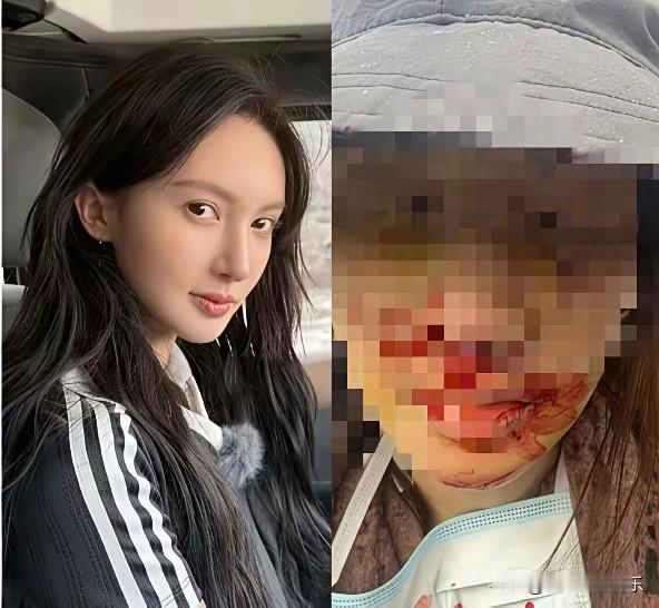 终于知道金晨为什么一直变脸，原来是车祸把鼻子整歪了，她才不得不放下助理火急火燎去