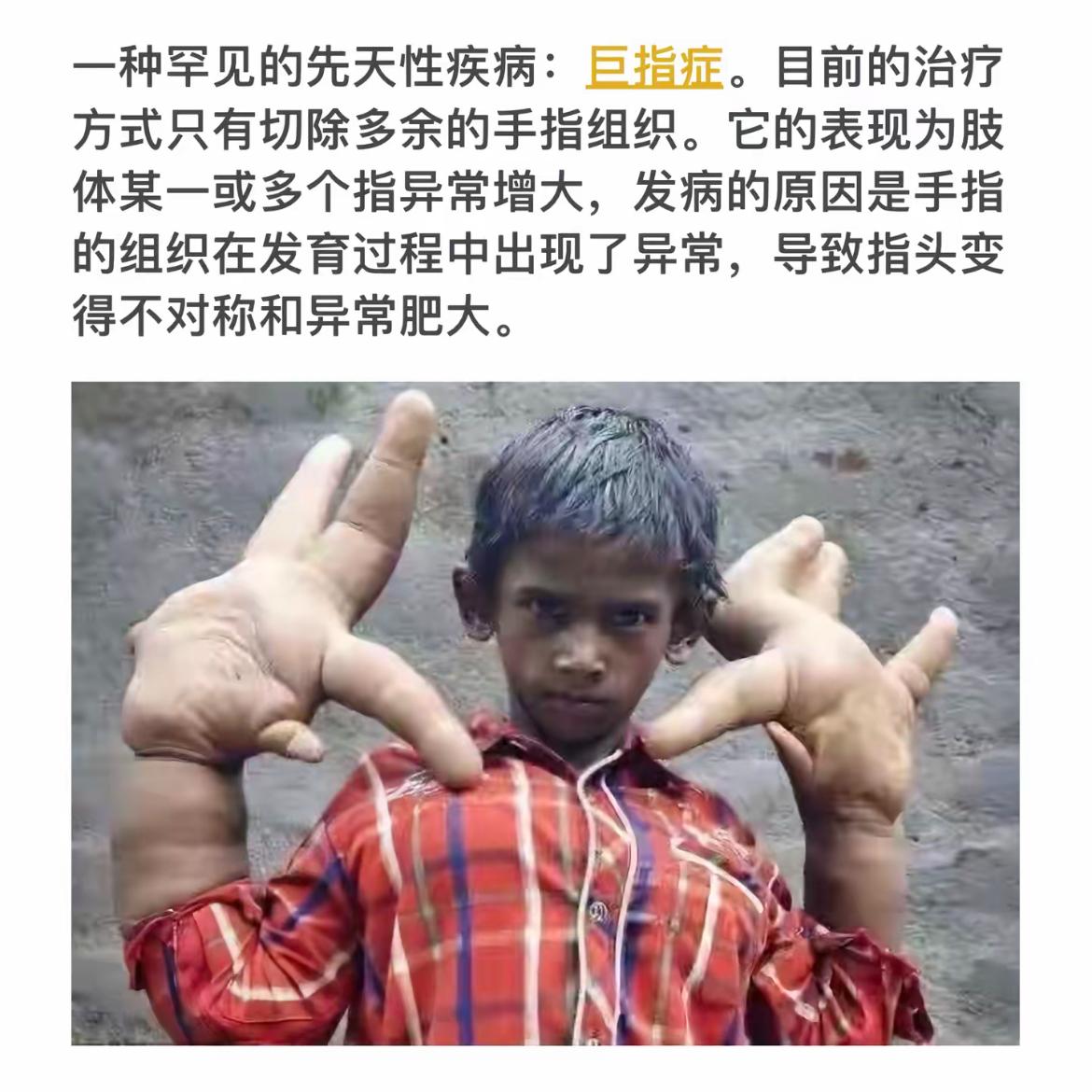 巨指症：罕见先天性疾病的挑战与希望