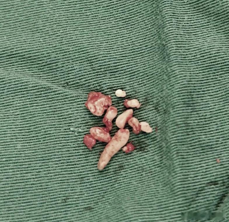 【女子总牙疼发现牙里密密麻麻全是牙】女子总牙疼查出一堆小牙齿9月7日（发布），