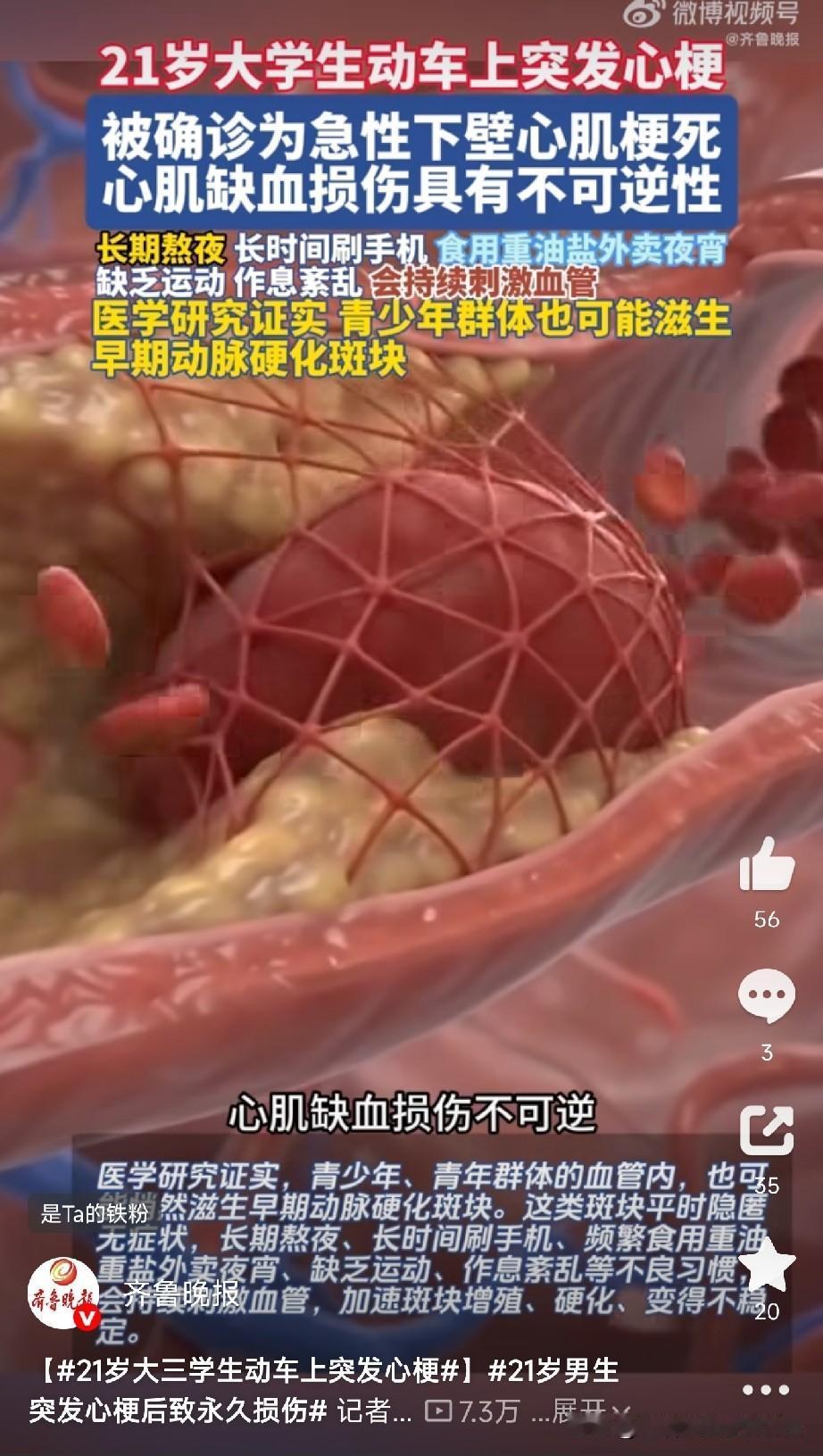 21岁大三学生动车上突发心梗！近日，浙大二院接诊了一个21岁大三男生小李。动