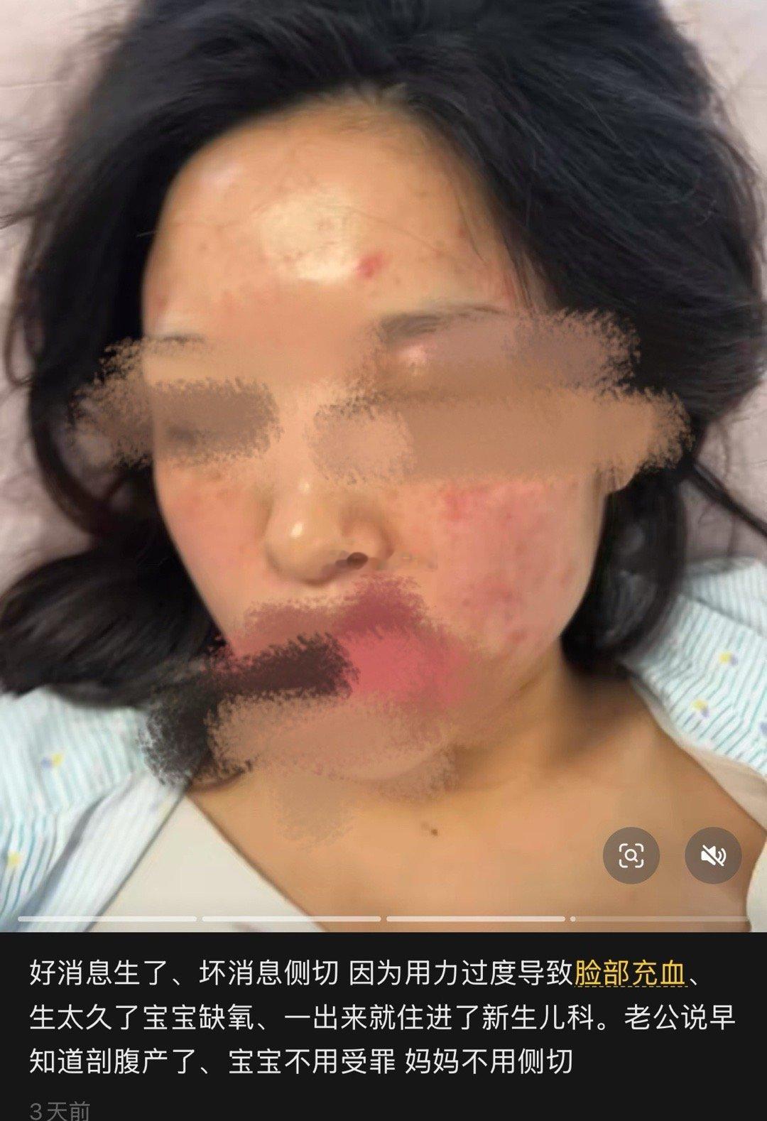 近视还会有视网膜脱落的风险