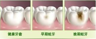 蛀牙怎么治疗好? 洗牙能让牙齿变白到底是真是假?