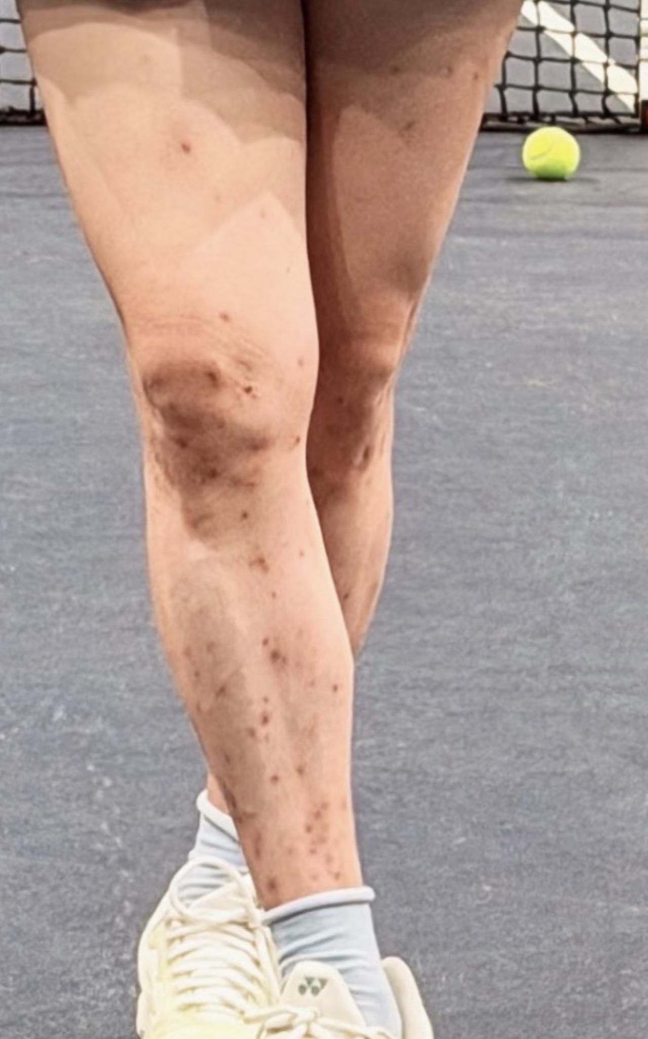 41岁杨天真在美国住的时候被跳蚤咬了，晒照穿短裙打网球，腿上全是又红又肿的大包，