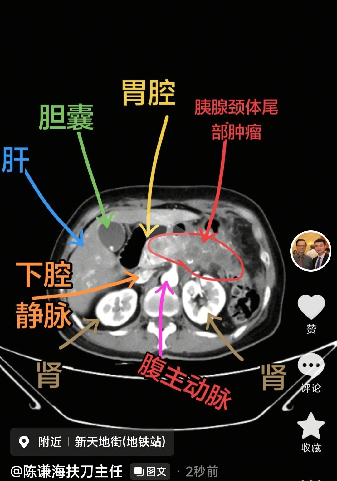 我们在临床中，根据胰腺肿瘤的位置，分为胰头癌，胰体癌，胰尾癌，1. 胰头癌：最常
