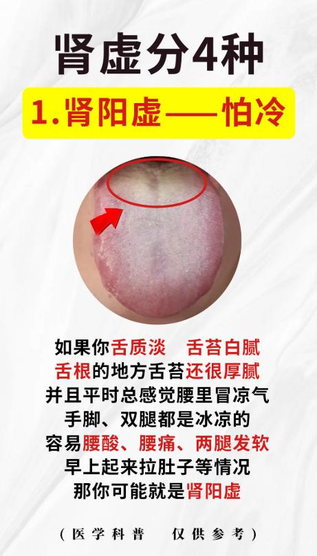 肾虚分4种，对照症状别乱补