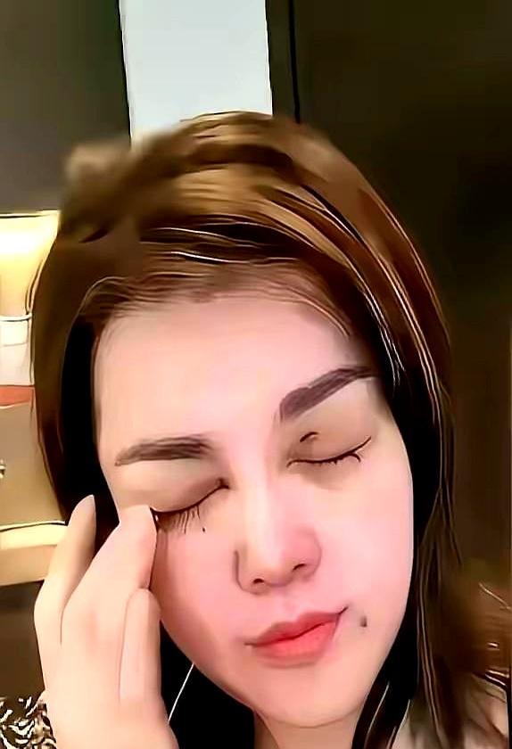 54岁脸每月挨刀，她图啥？视频里那块青紫还在，手指一揉就说是吸收。