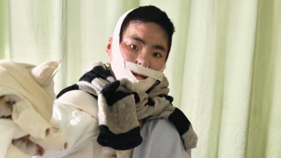 女孩被前男友泼汽油致残,凶手法庭上威胁杀人