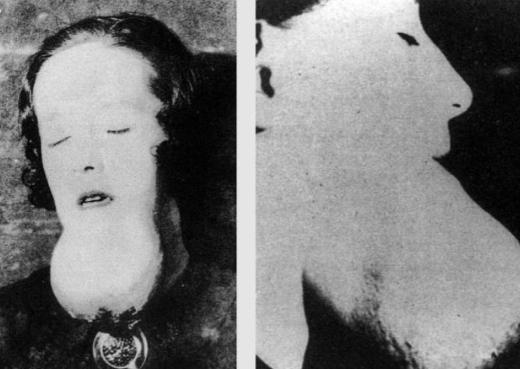 1922年，一名25岁的花季少女因为牙疼去看病，当医生轻轻触碰牙齿时，她的下颚骨
