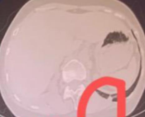 “刚切掉一个，怎么又长一个？难道要我把整个肺都切了吗？”61岁的梁姨从外地赶来复