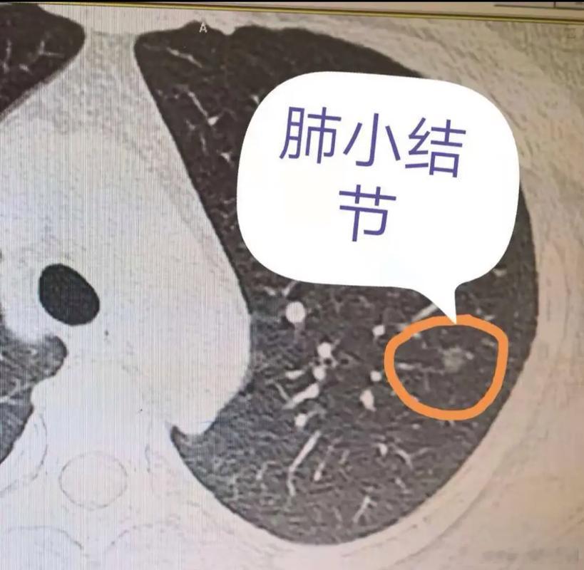 什么样的腰痛要及时就医世界脊柱日全民疼痛疾病攻略【肺结节要少吃高盐分和刺激性食