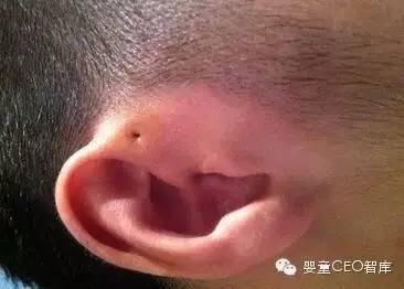 宝宝耳朵旁这个小洞