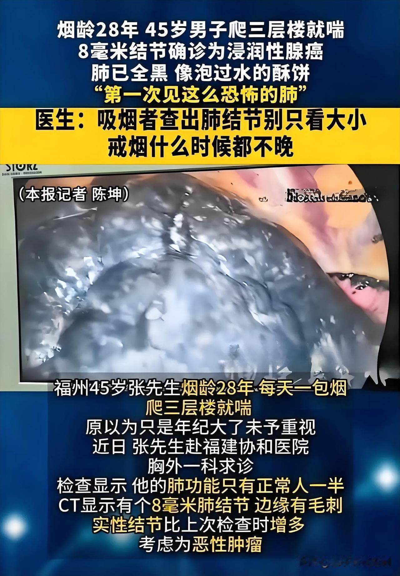 近日，52岁的老陈因持续咳嗽、胸闷到医院就诊，CT检查结果显示双肺大面积发黑，已