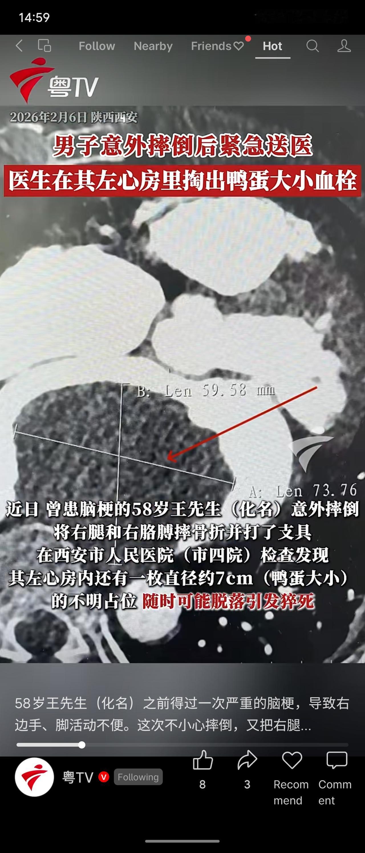一名58岁曾患脑梗的男子因意外摔倒骨折，送医后竟发现其左心房内藏有一个直径约7厘