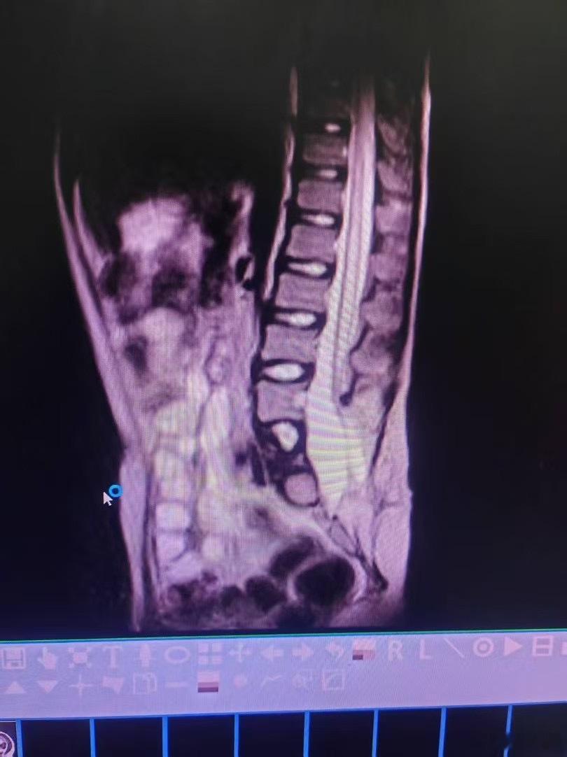 介绍一可怜的揭阳市普宁县12岁男孩，医学同行们一看所有影像资料就知道多么严重：先