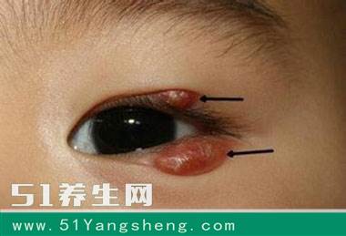 宝宝双眼红肿长痘, 无知婆婆挤压出脓头, 既不知是把宝宝推向危险边沿, 双眼差点……