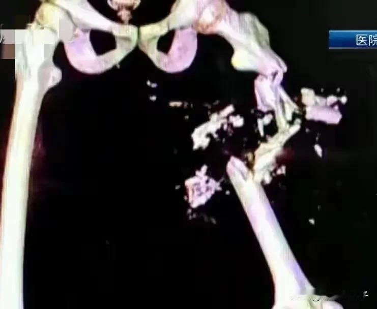 15.75厘米！800天“骨搬运”，让断骨重生的奇迹。谁能想到，腿骨缺损近