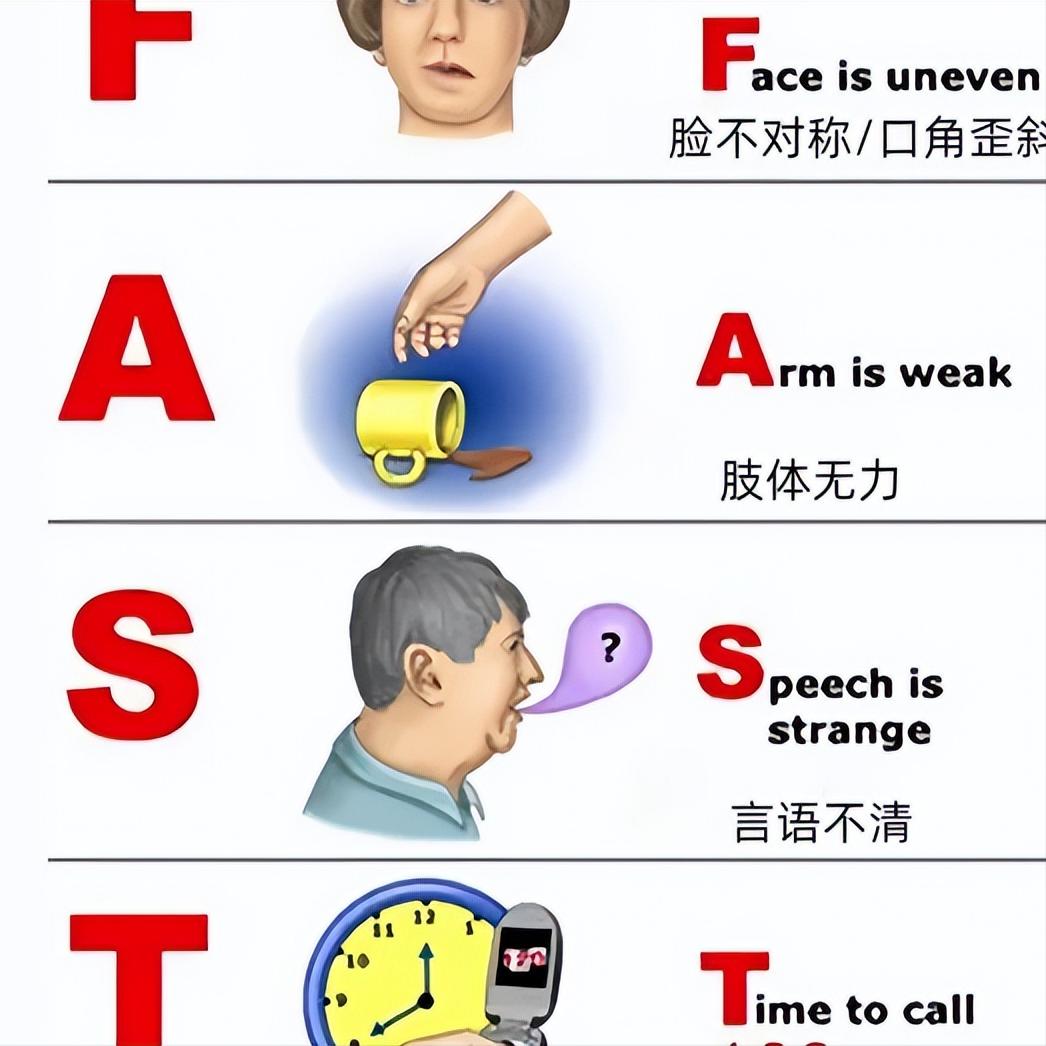 脑梗发作4.5小时，记住这4个字母，关键时候能救命！F（Face）：笑一笑，