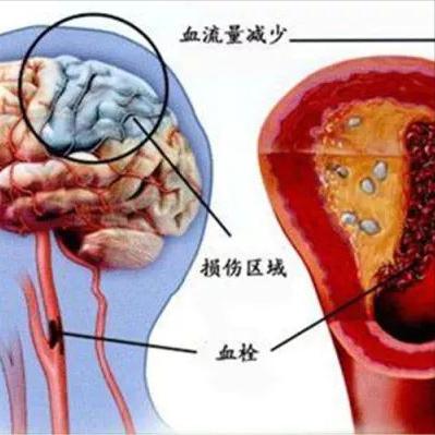 不想得脑梗？3个日常习惯要坚持  1.保持充足的水分多喝水就行，是很日