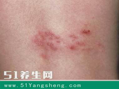 长期佩戴隐形眼镜竟然戴出了带状疱疹! 后果太可怕了