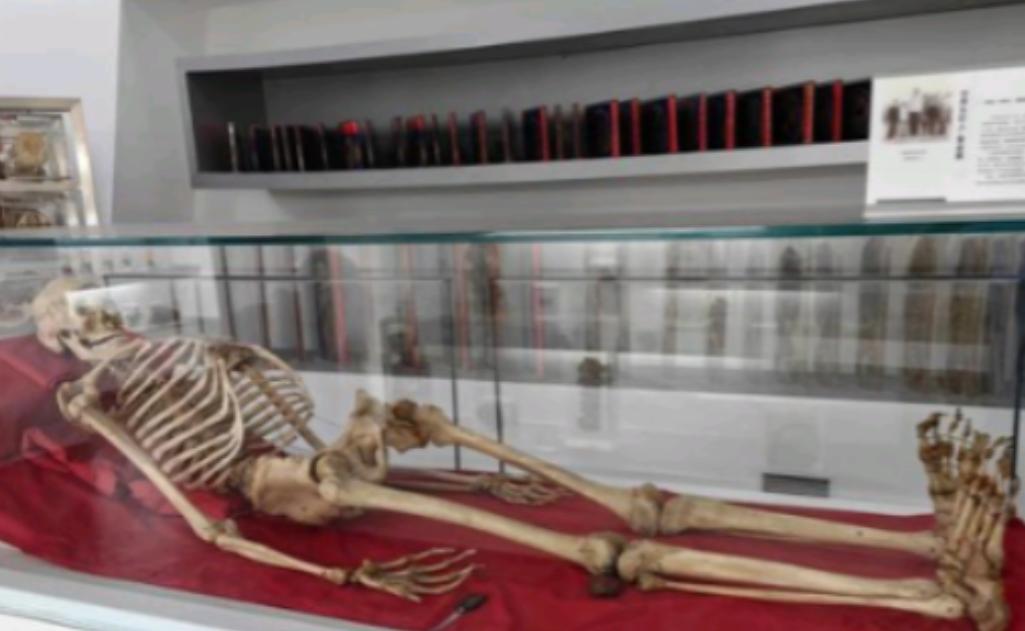 2005年，湖南湘雅医学院的标本室里，放着中国“第一女巨人”曾金莲的遗体，白布包