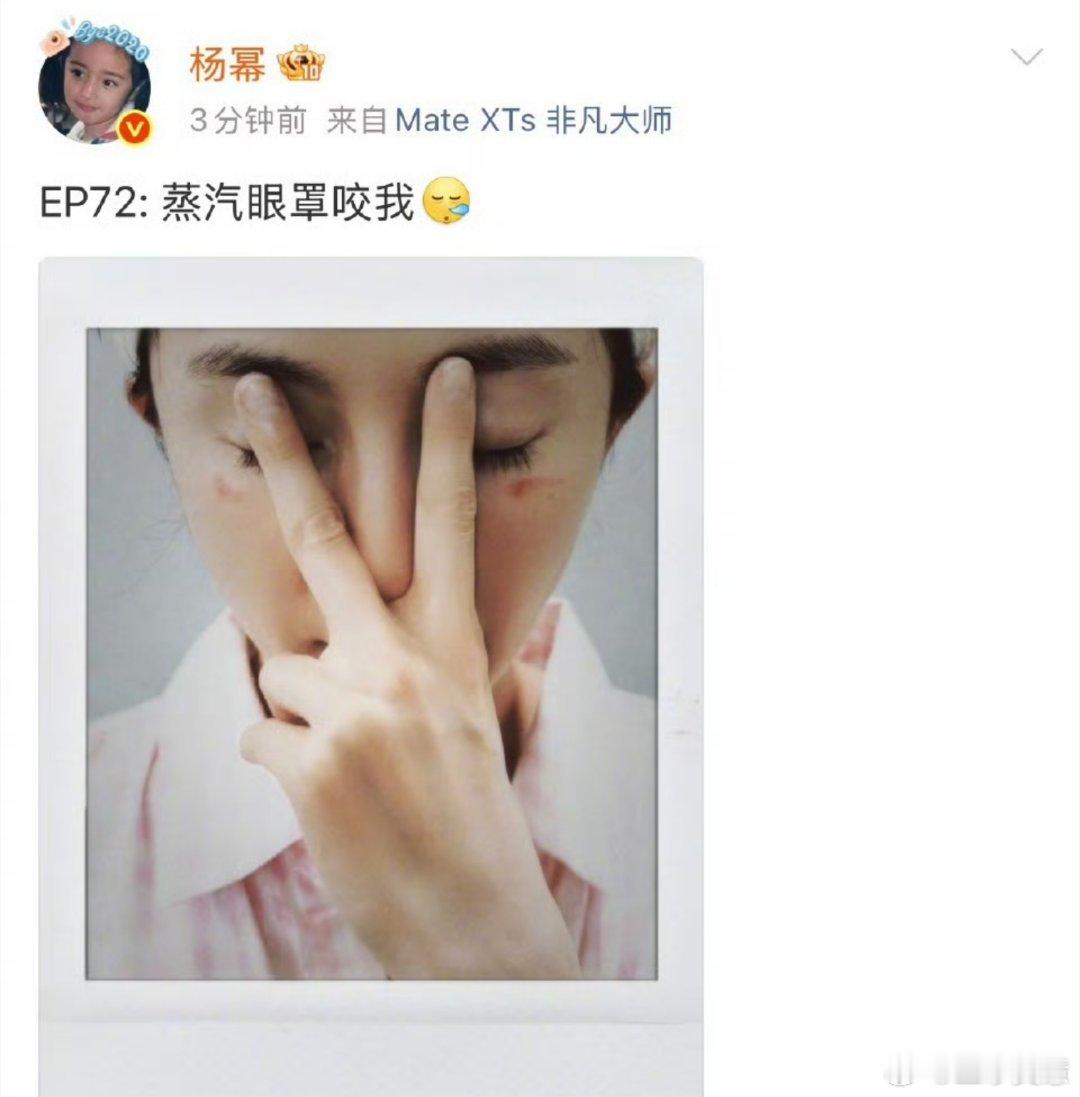 杨幂脸被蒸汽眼罩烫伤了蒸汽眼罩真的很危险大家使用的时候一定要注意杨幂的脸都被蒸汽