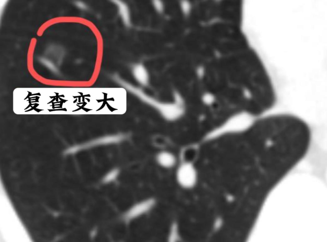 短短3个月，肺上的磨玻璃结节从4mm长到了9mm！任谁听到这样的变化，都会心头一