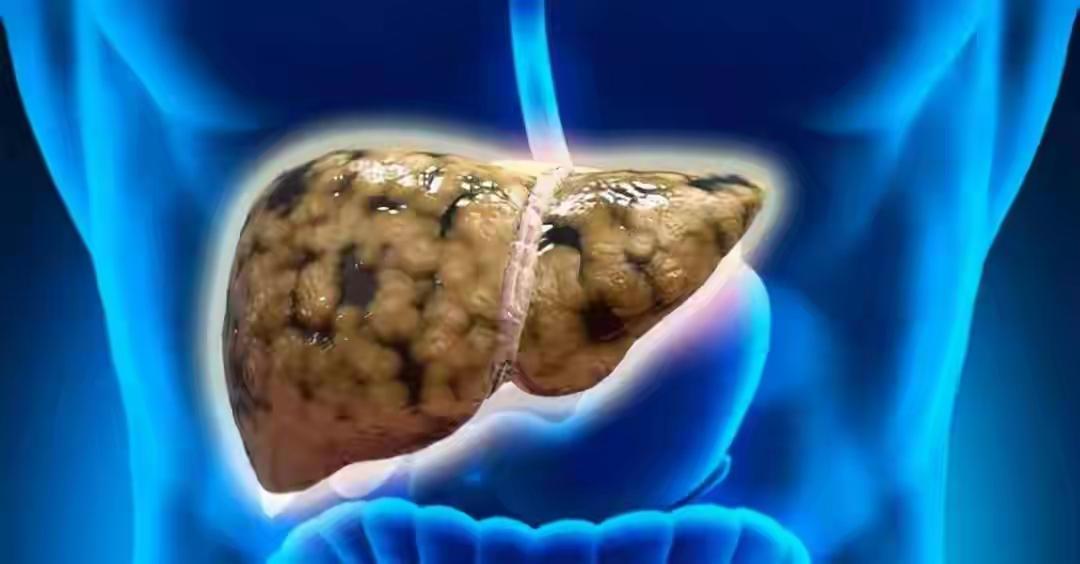 脂肪肝与早餐有关？建议：一旦患上脂肪肝，这5种早餐尽量少吃内容严格依据《中国